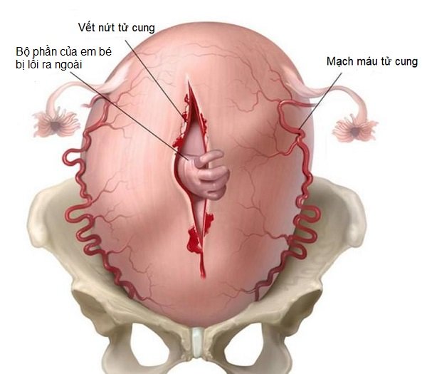 Vỡ tử cung là gì? Dấu hiệu nhận biết và cách chăm sóc