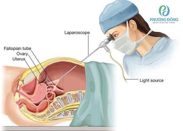 Phẫu thuật nội soi thai ở ngoài tử cung áp dụng khi thai nằm ở vòi trứng và thai nằm ở ống dẫn trứng