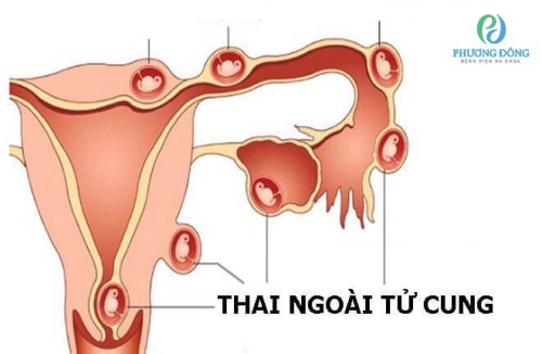  Bác sĩ giải đáp: Thai ngoài tử cung có sinh được không?