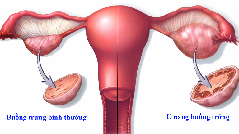 Tại sao kiêng quan hệ tình dục là một lưu ý sau khi mổ u nang buồng trứng?
