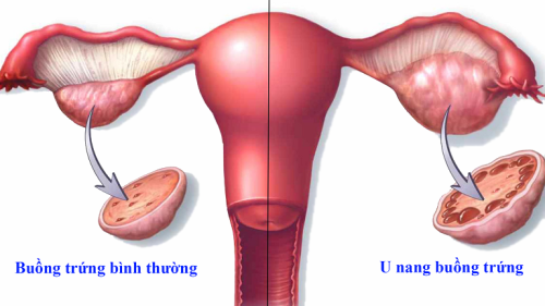 Mổ u nang buồng trứng và những lưu ý sau khi mổ