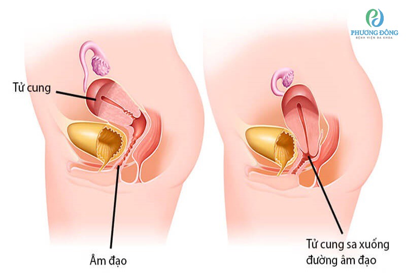 Cách phân biệt tử cung bình thường và sa tử cung