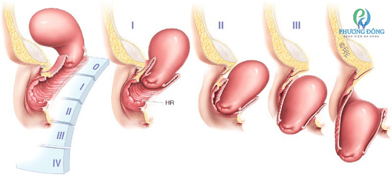 Hình ảnh 4 giai đoạn khi mẹ bầu mắc sa tử cung
