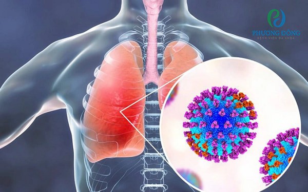 Cúm mùa gây ra biến chứng viêm phổi