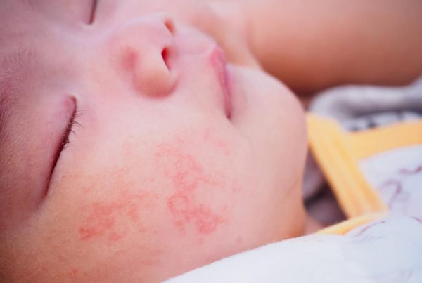 Hình ảnh các nốt ban đỏ nhỏ nổi lên quanh miệng sau khi trẻ bú sữa công thức.