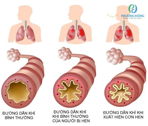 Tình trạng phổi và đường thở của người hen suyễn 