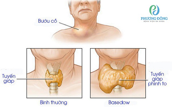 Phân biệt bệnh bướu cổ và bệnh bazơđô qua triệu chứng điển hình