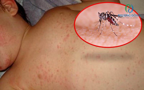 Người bệnh sốt xuất huyết bị nổi mẩn đỏ do muỗi vằn cái chích