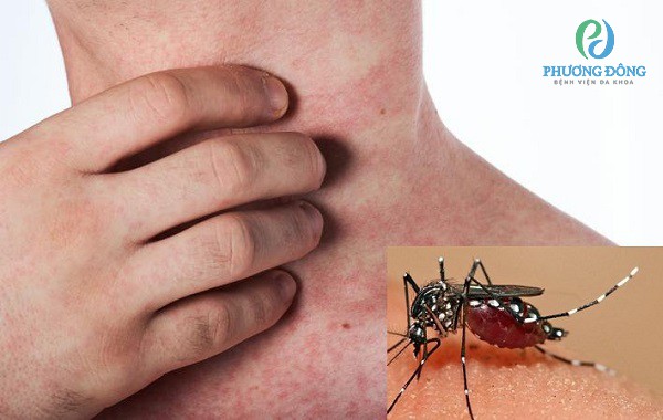 Nhiễm sốt xuất huyết do muỗi thuộc chi Aedes đốt