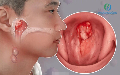 Ung thư xoang mũi: Dấu hiệu cảnh báo, phương pháp điều trị và cách phòng ngừa
