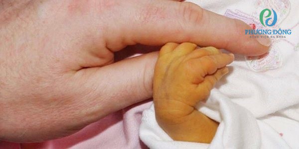 Chủ yếu trẻ sơ sinh bị vàng da lòng bàn tay bàn chân do sinh thiếu tháng
