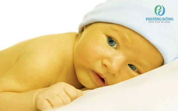Trẻ sơ sinh có thể bị vàng da 