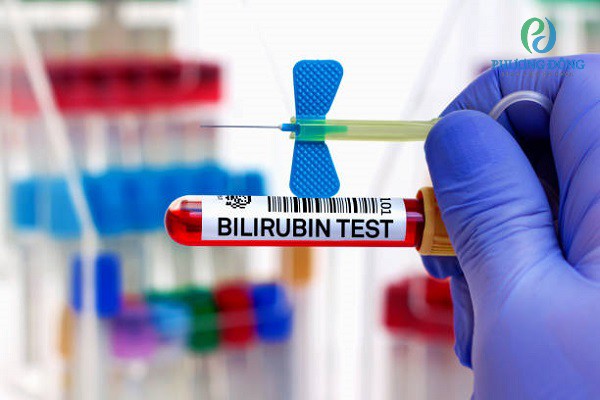 Xét nghiệm máu để định lượng bilirubin 