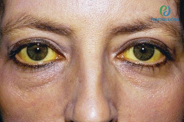 Bilirubin tăng khiến niêm mạc mắt chuyển sang màu vàng