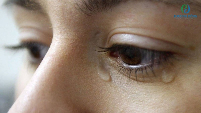 Tình trạng khô vùng mắt kích thích khiến cho nước mắt chảy liên tục
