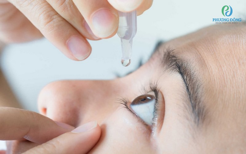 Các bác sĩ nhãn khoa khuyên dùng nên sử dụng nước mắt nhân tạo