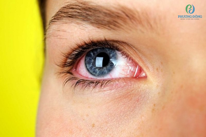 Do mắt bị khô do đó những tế bào của mắt rất dễ bị tổn thương và đỏ
