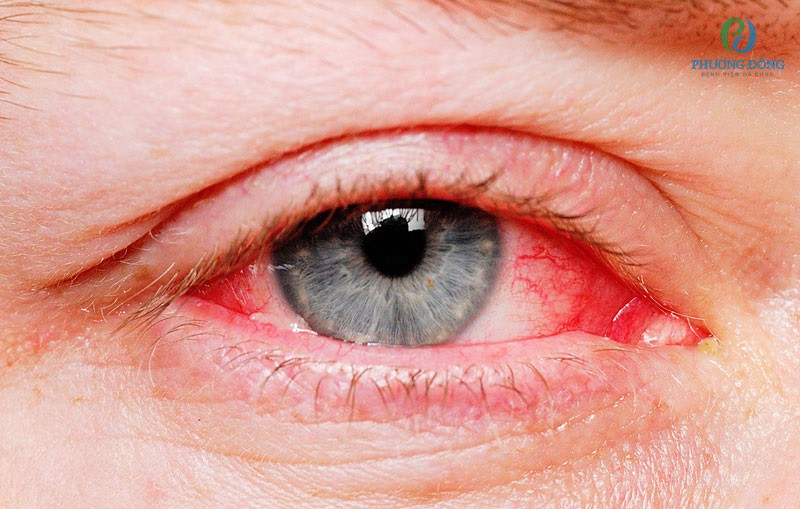 Nếu như không điều trị sớm tình trạng khô mắt có thể dẫn đến viêm kết mạc đỏ