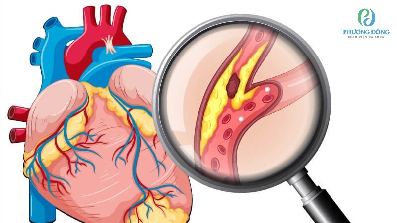 Suy tim giai đoạn 3 có nguy cơ bị đột quỵ