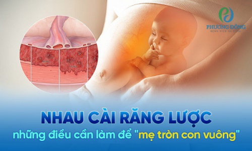 Nhau cài răng lược - tai biến sản khoa nguy hiểm mẹ bầu cần nắm rõ