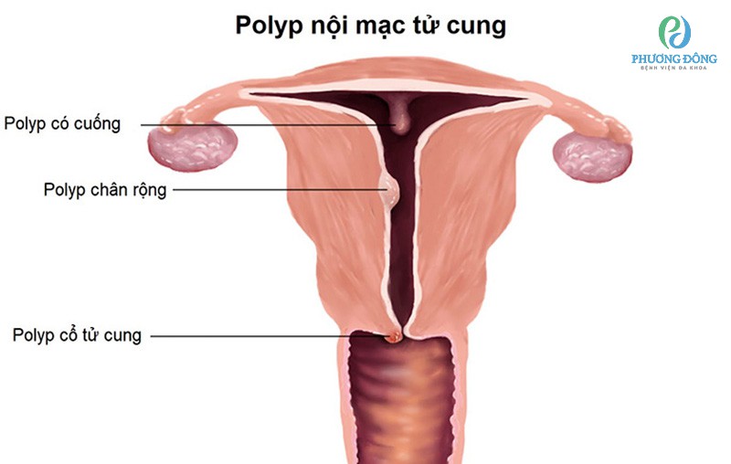Polyp ở cổ tử cung là một trong những tác nhân gây ra hiện tượng cường kinh