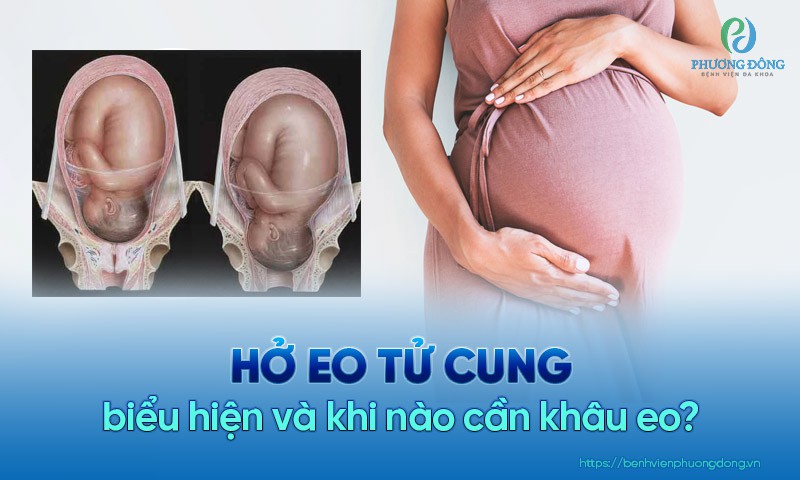 Hở eo tử cung là tình trạng cổ tử cung xóa mở nút nhầy trước ngày dự kiến sinh