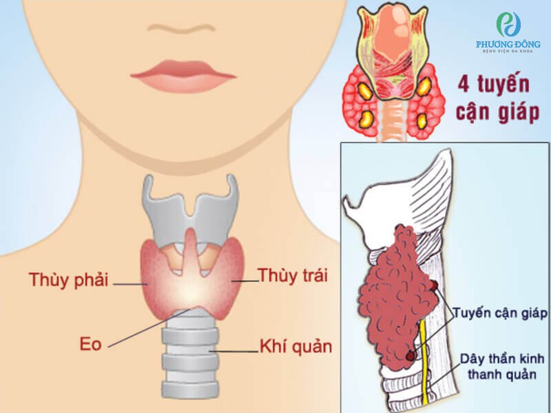 Bệnh nhân suy cận giáp bị thiếu hormon cận giáp PTH có thể gây ra giảm nồng độ Calci