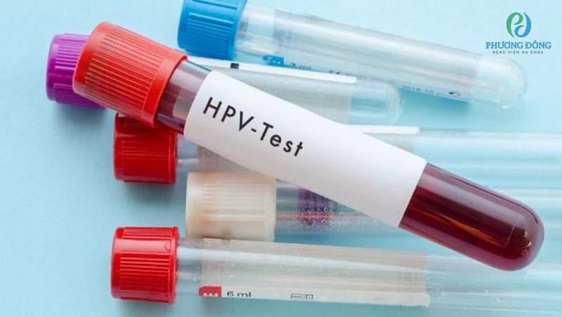 Xét nghiệm virus HPV giúp tầm soát bệnh ung thư cổ tử cung ở phụ nữ