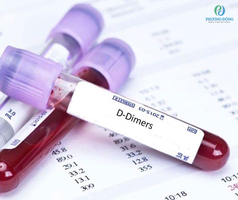Xét nghiệm D-dimer là phương pháp để có thể nhận biết có huyết khối 