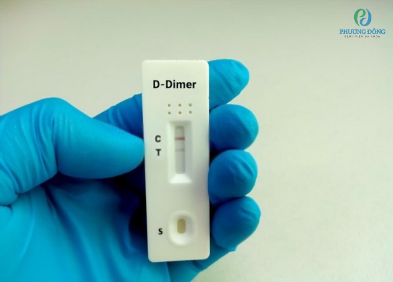 Nếu kết quả xét nghiệm D-dimer âm tính nghĩa là bạn không có huyết khối