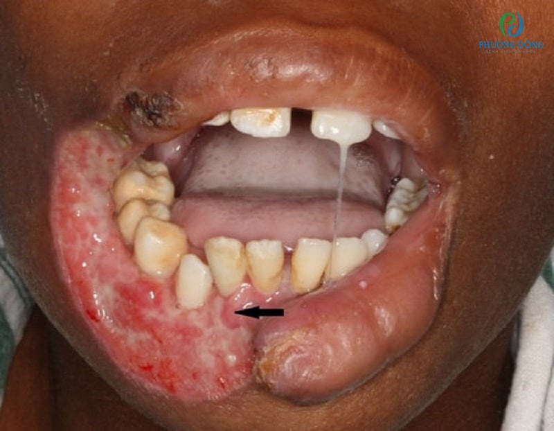 Bệnh nhân bị hoại tử vùng miệng do mắc bệnh noma