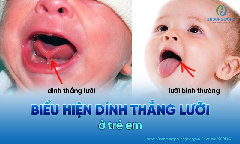 biểu hiện dính thắng lưỡi ở trẻ sơ sinh
