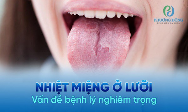 Tình trạng tổn thương thường gặp gây đau đớn có thể là nhiệt ở lưỡi