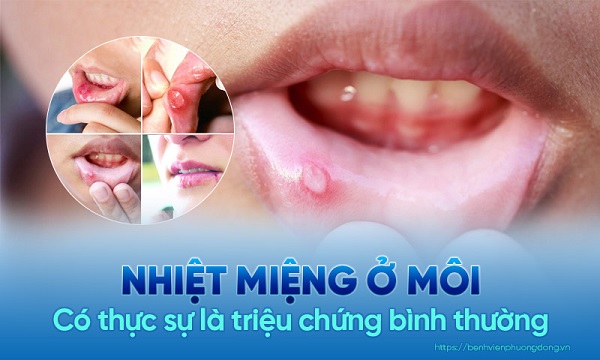 Nếu bị lở miệng ở môi, nên làm gì để giảm triệu chứng?
