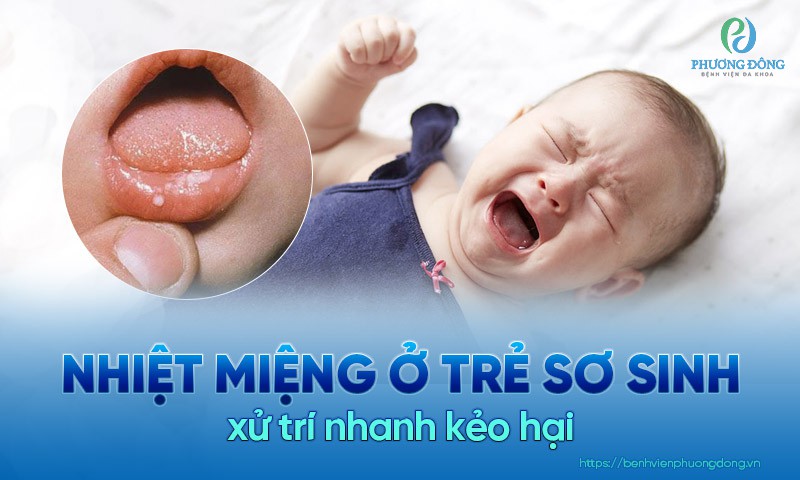 Tác động của nhiệt miệng đến sức khỏe và tăng nguy cơ nhiễm trùng ở trẻ sơ sinh?
