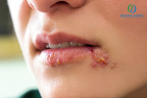 Tình trạng Herpes ở môi