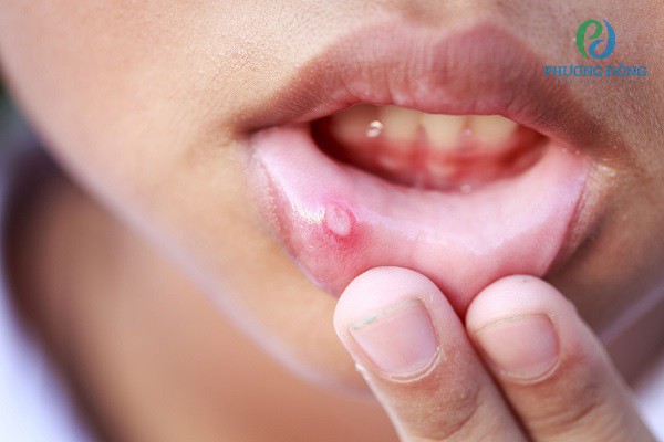 Nhiệt miệng xuất hiện ban đầu với vết đốm trắng, to khoảng 1 - 2 mm