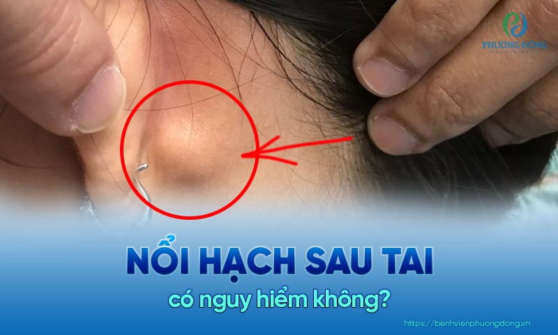 Nổi hạch sau tai là một trong những hiện tượng thường gặp