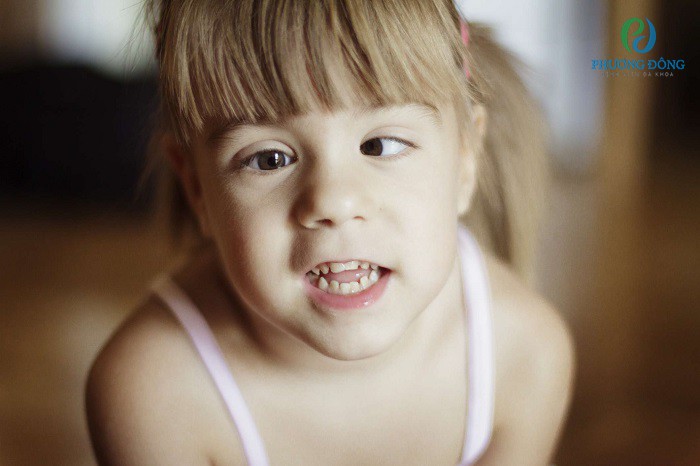 Cần đưa trẻ tới phòng khám mắt khi trẻ có hiện tượng nheo mắt, không nhìn đúng trọng tâm
