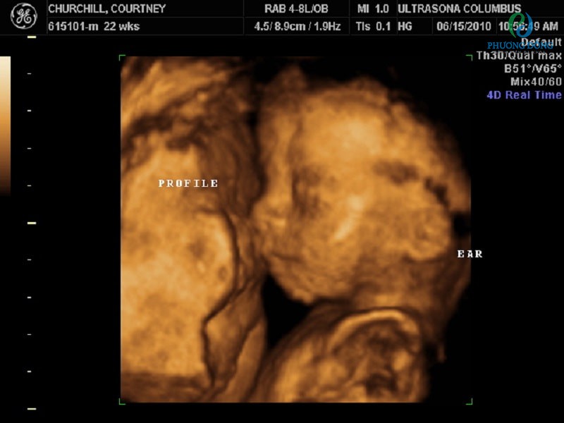 Hình ảnh siêu âm 4d thai 22 tuần