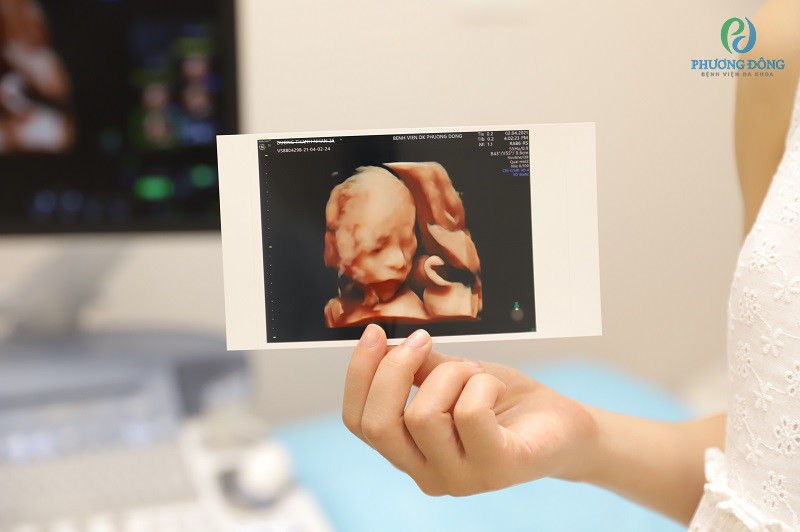 Siêu âm thai có thể xác định được tuổi thai