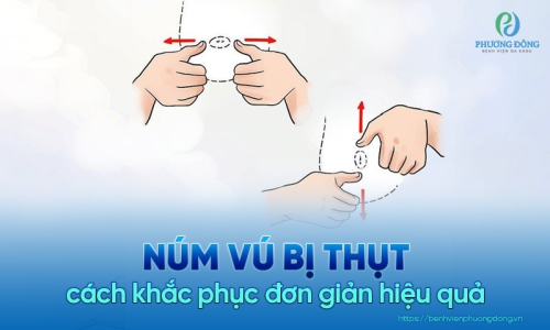 Tụt núm vú và cách khắc phục đơn giản hiệu quả