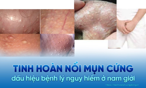 Tinh hoàn nổi mụn cứng - Dấu hiệu bệnh lý ở nam giới