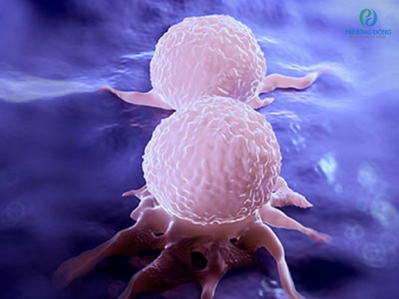 Ung thư di căn là giai đoạn khối u tách khỏi vị trí nguyên phát ban đầu