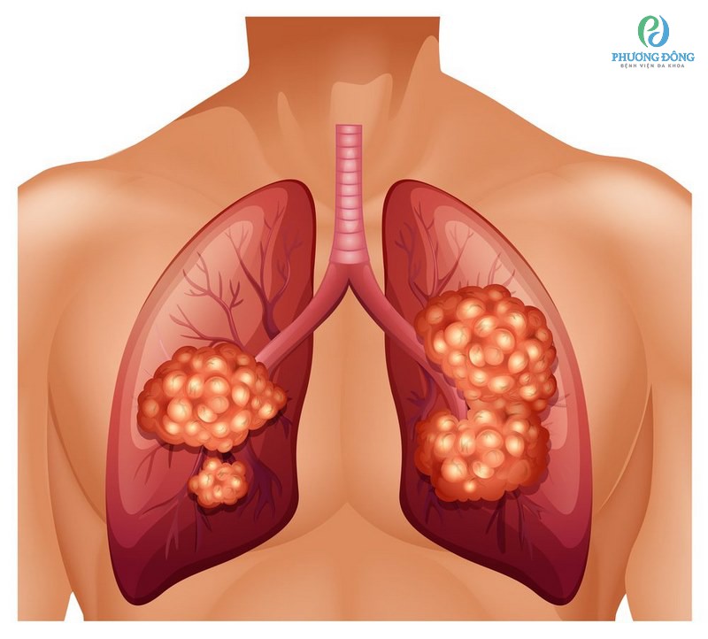 Ung thư di căn vào phổi rất nguy hiểm cho người bệnh