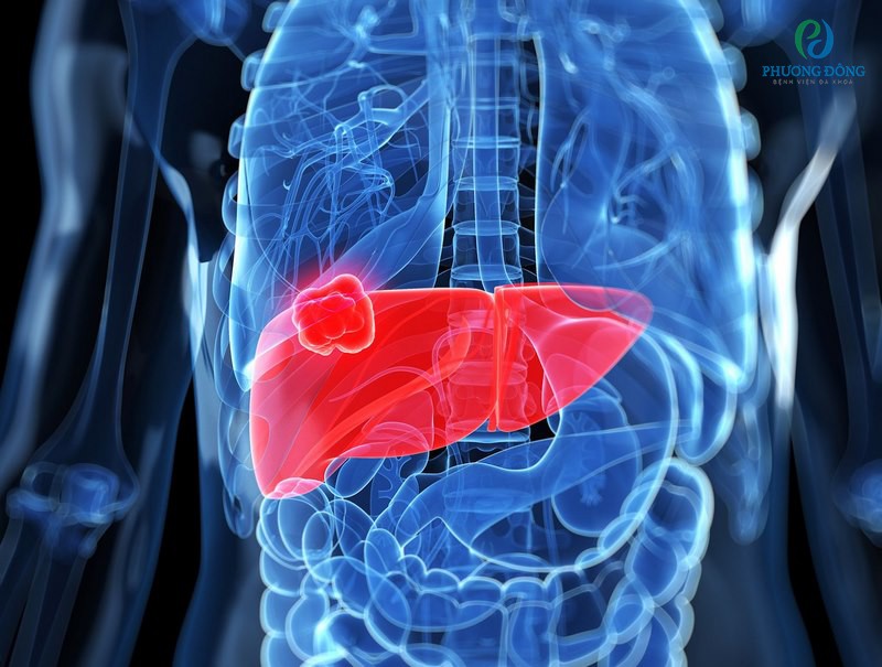 Khi khối u di căn vào gan khiến bệnh nhân sụt cân nhanh chóng