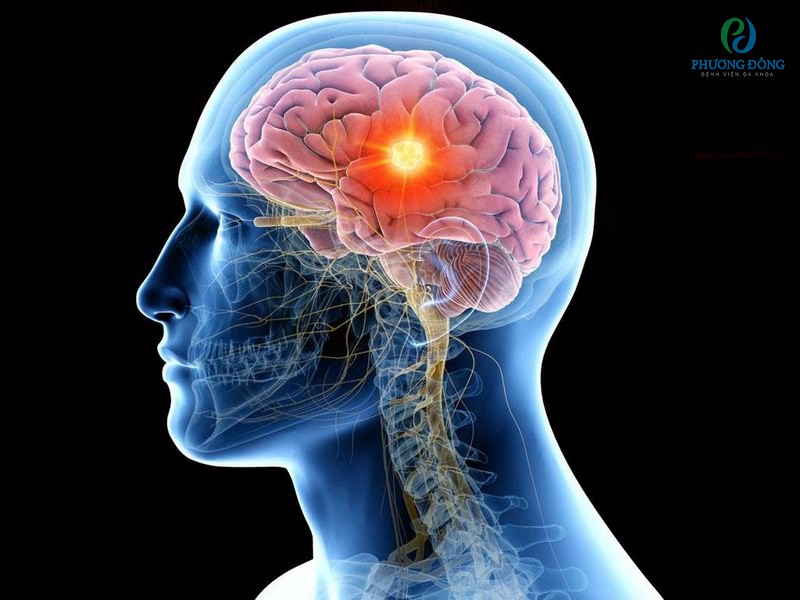 Ung thư di căn lên não dẫn đến những biến chứng nghiêm trọng