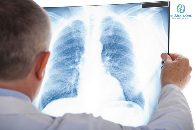 Chụp X quang là phương pháp chẩn đoán ung thư di căn xương phổ biến