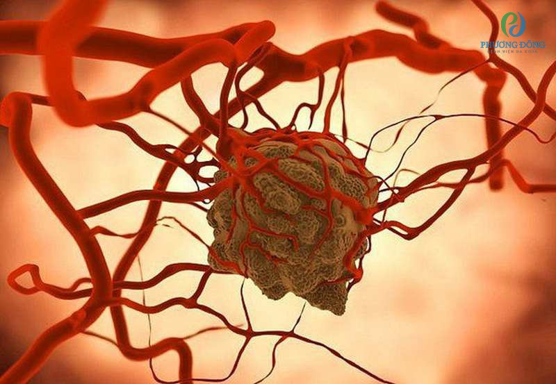 Tế bào ung thư di chuyển qua các mạch máu đến các bộ phận khác