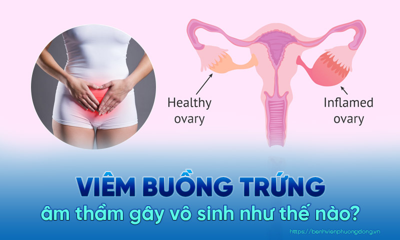 Nguyên nhân gây ra viêm buồng trứng là gì?
